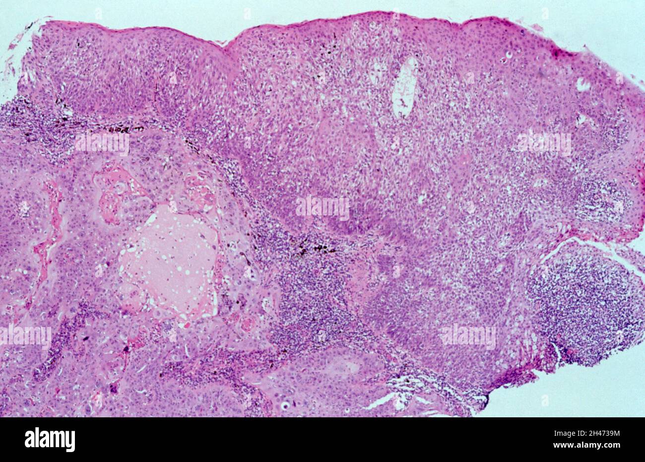 Carcinome in situ Banque de photographies et d’images à haute résolution Alamy