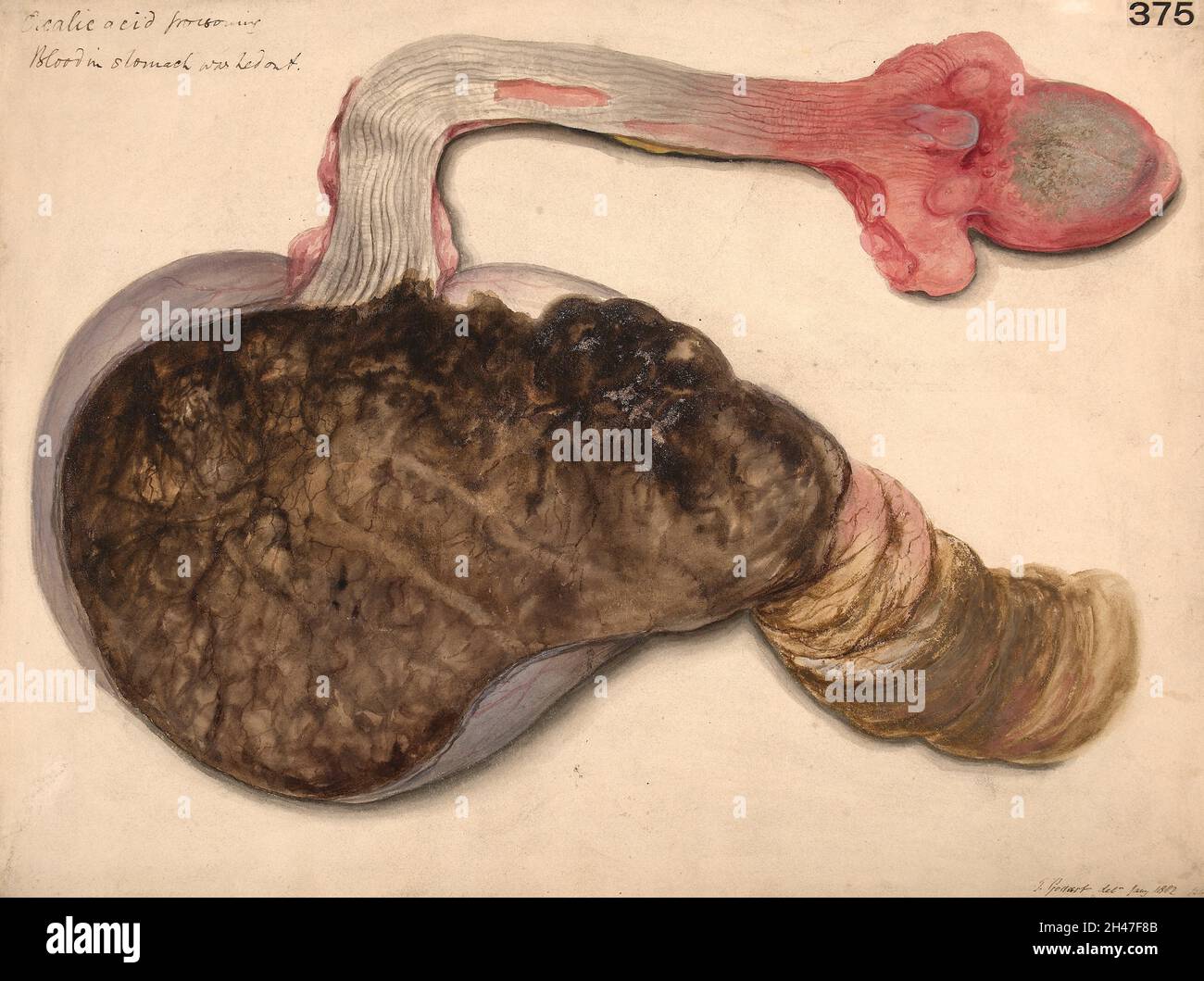 Langue, oesophage et estomac d'un cas d'intoxication à l'acide oxalique Banque D'Images