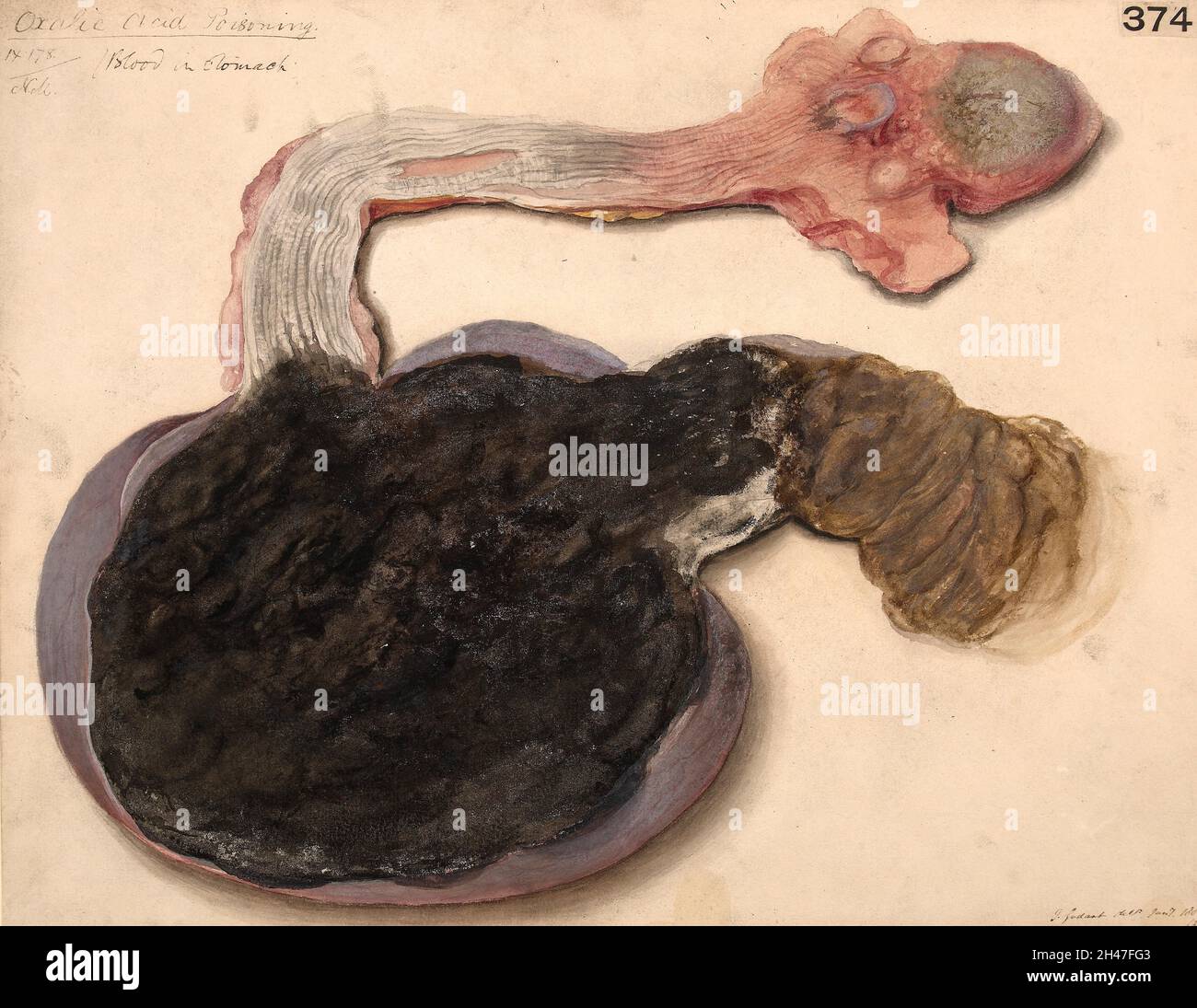 Langue, oesophage et estomac d'un cas d'intoxication à l'acide oxalique Banque D'Images
