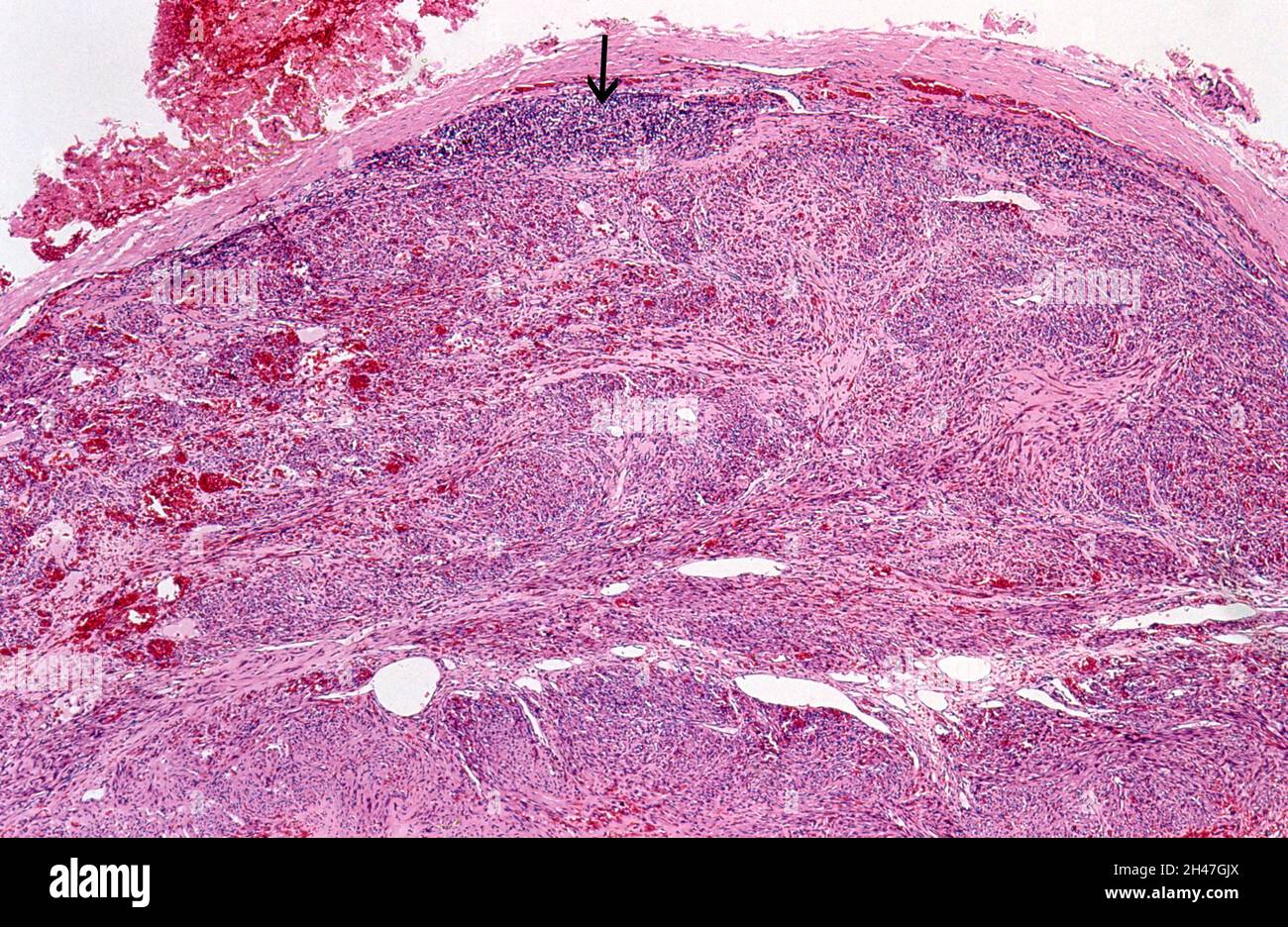 Ganglion lymphatique : sarcome de Kaposi Banque D'Images