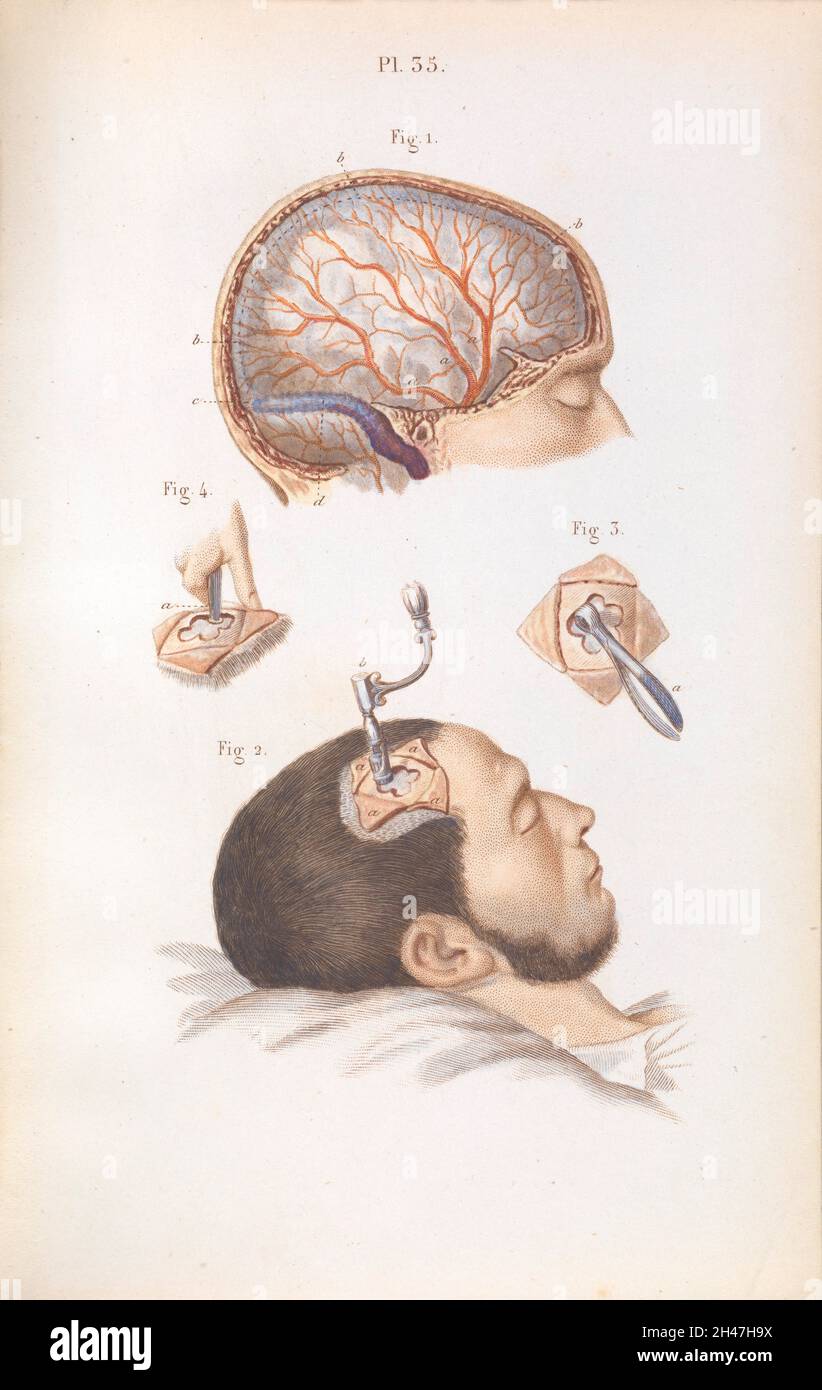 Plaque 35, trepanation du crâne. Banque D'Images