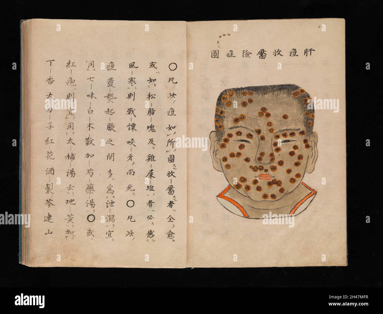 Illustration de la variole, manuscrit japonais, c.1720 Banque D'Images