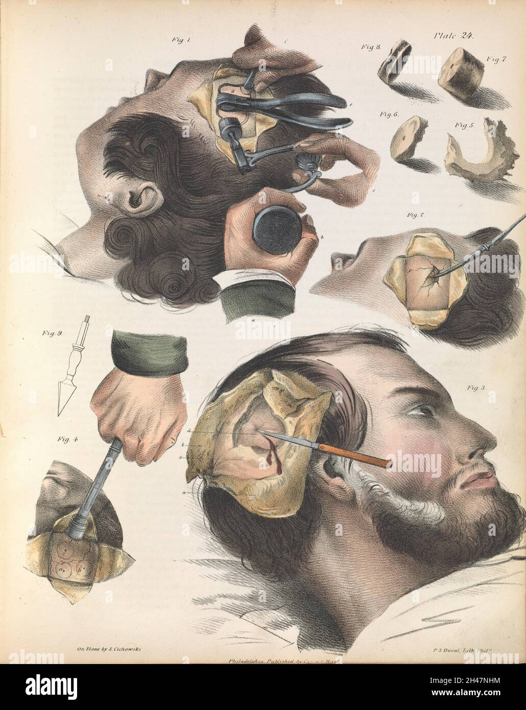 Plaque XXIV.Trepaning ou trephining du crâne. Banque D'Images