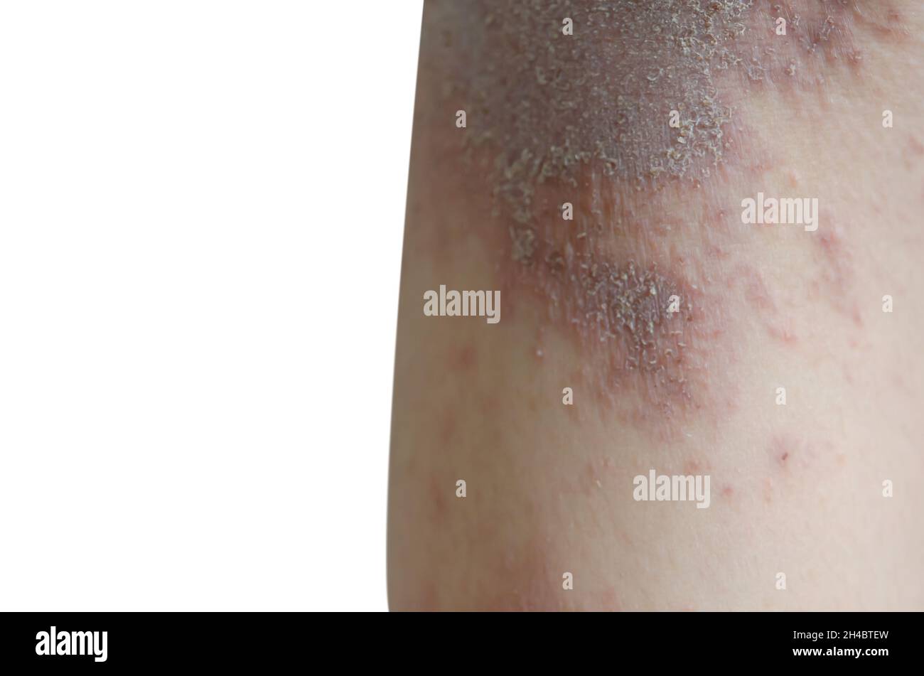 Éruption cutanée et peau sur la jambe, isolée sur fond blanc Photo Stock Alamy