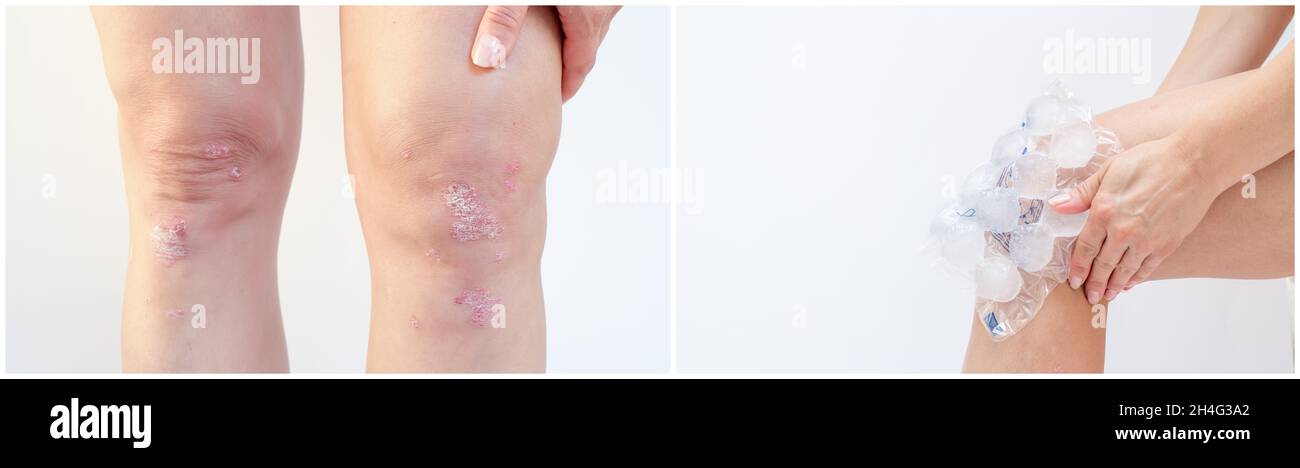 Collage rapproché d'arthrite psoriasique aiguë sur les genoux et de lésions ménisques.Excès de liquide synovial dans et autour de l'articulation du genou.La main d'une femme tient un Banque D'Images Collage rapproché d'arthrite psoriasique aiguë sur les genoux et de lésions ménisques.Excès de liquide synovial dans et autour de l'articulation du genou.La main d'une femme tient un Banque D'Images