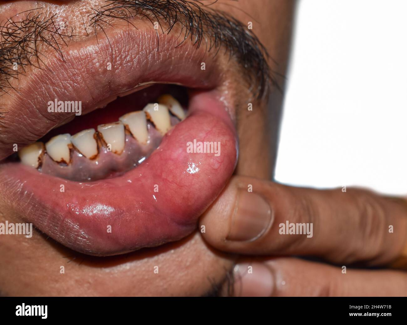 Abcès ou kyste avec pus à la lèvre inférieure de l'homme asiatique ...