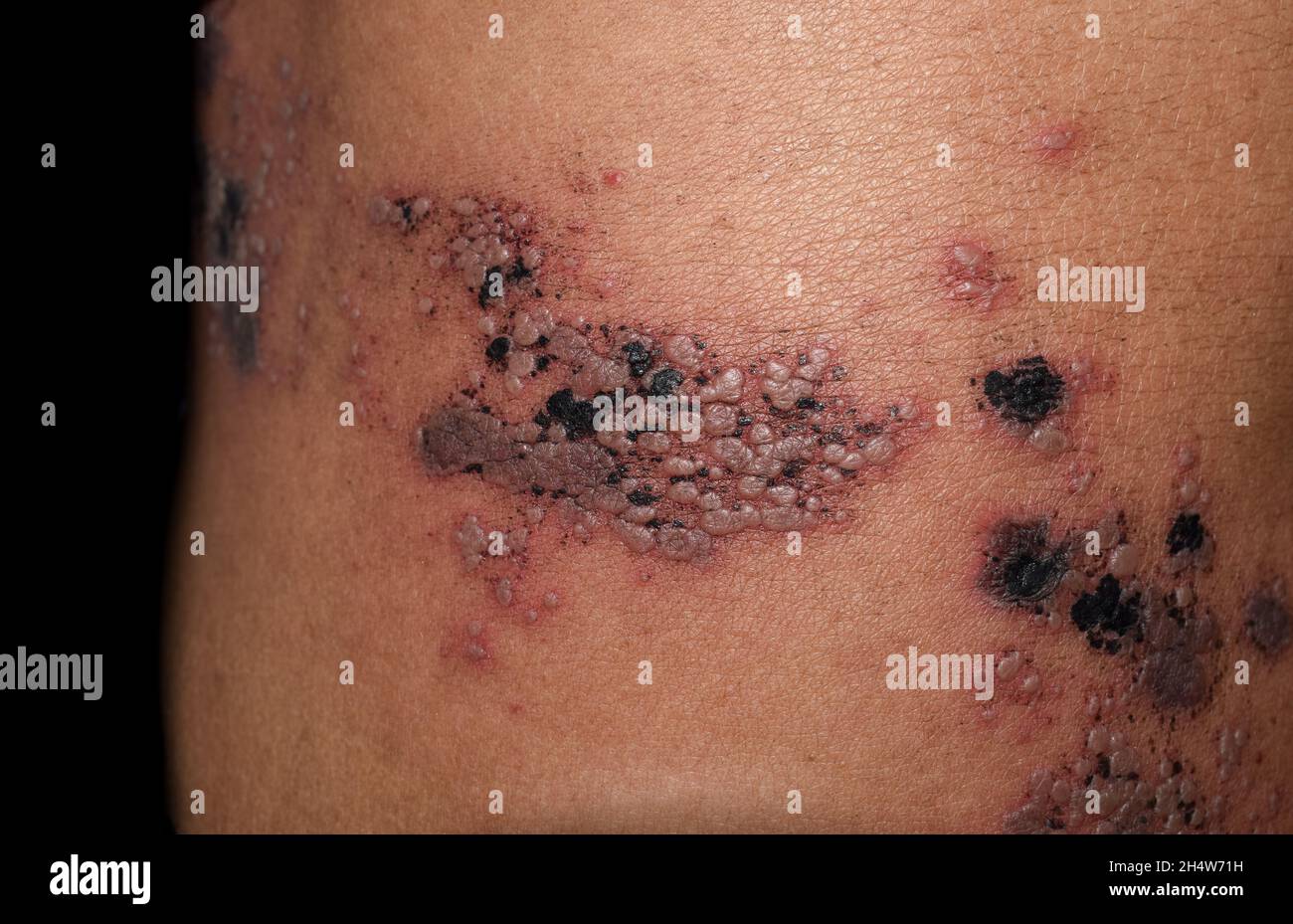 Infection simplex d'herpès à l'abdomen de la femme asiatique.Petites vésicules douloureuses. Banque D'Images Infection simplex d'herpès à l'abdomen de la femme asiatique.Petites vésicules douloureuses. Banque D'Images