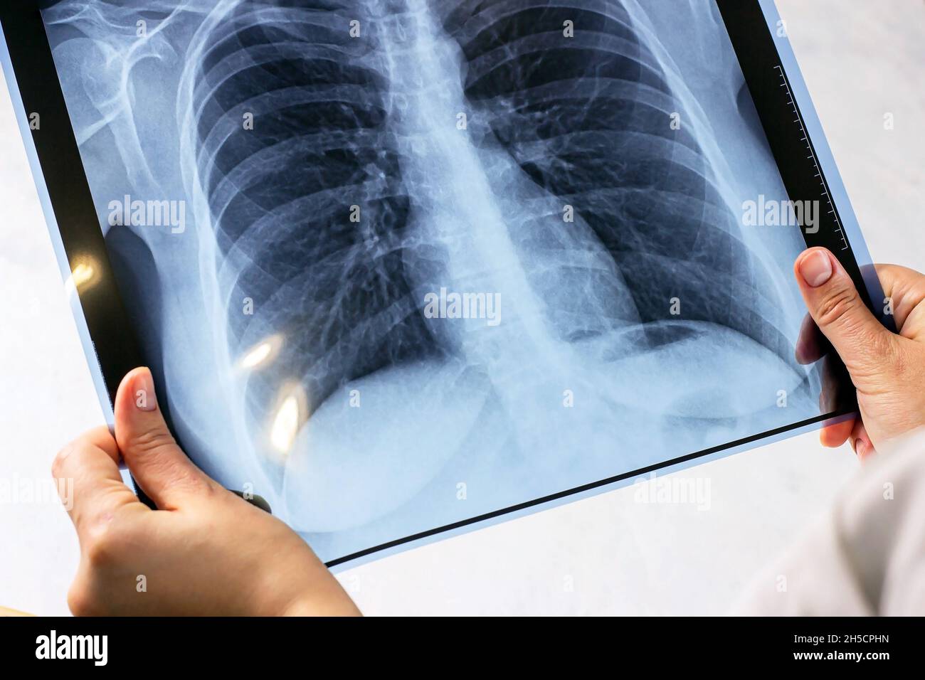 Mains de femme avec une radiographie médicale bleue de l'acquisition thoracique sur fond clair.Diagnostic de la défacilité Covid, de l'examen du cancer, de la pneumonie, de l'asthme et de la tuberculose Banque D'Images