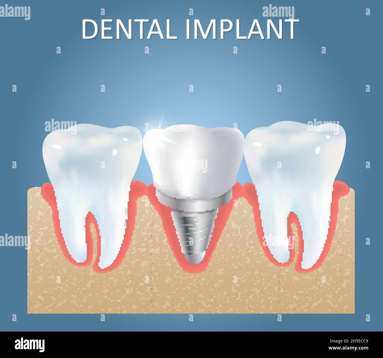 Modèle d'affiche médicale vecteur d'implant dentaire Illustration de Vecteur
