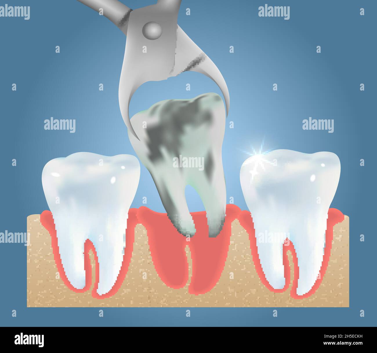 Modèle de conception d'affiche médicale à vecteur d'extraction dentaire Illustration de Vecteur