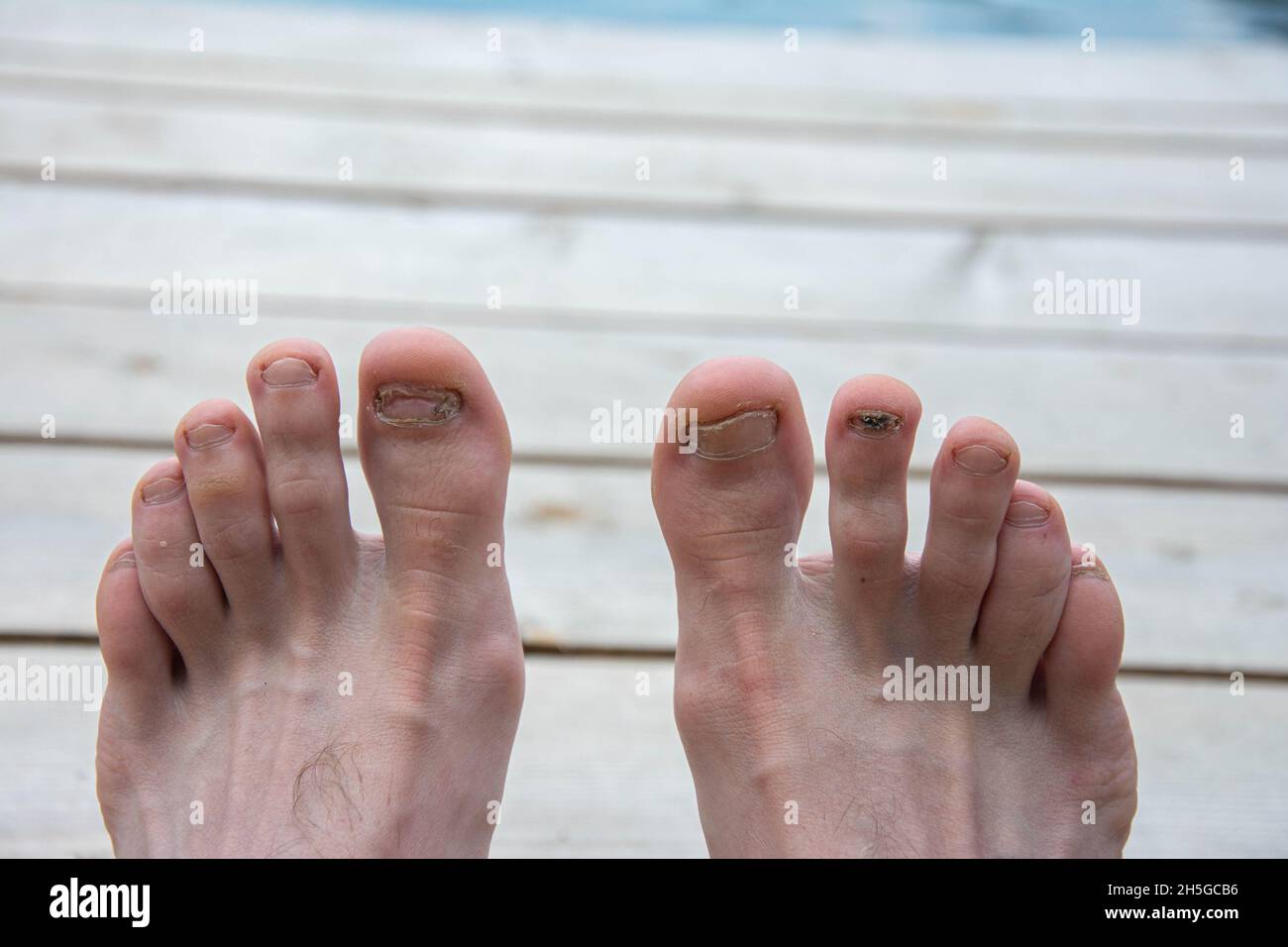 blessure d'un ongle noirci ébréché dans un traitement et la prévention de l'homme .Blessure aux orteils - ongle du pied noir Banque D'Images