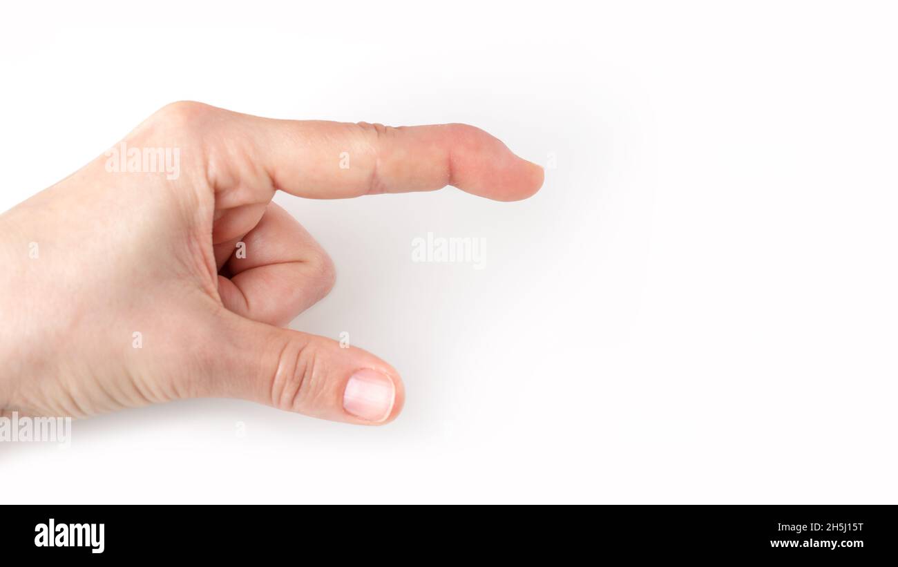 partie de la main gauche montrant la direction vers le bas, index avec une lésion du tendon extenseur pointant vers le bas, extrémité du doigt du maillet courbant vers le bas, déformation dans le dernier os phalangien, affiche Banque D'Images