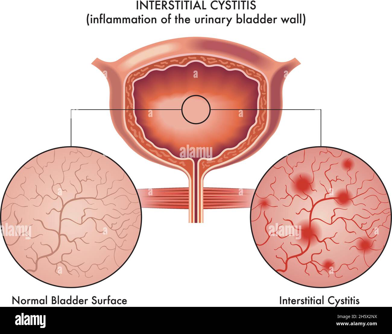 Illustration médicale des symptômes de la cystite interstitielle. Illustration de Vecteur