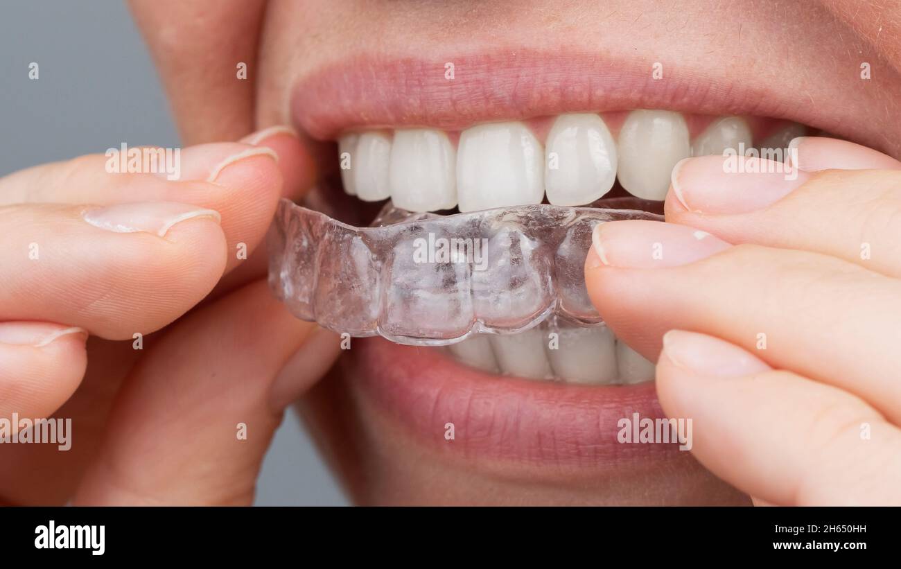 Femme caucasienne mettant sur des aligneurs.Dispositif de lissage des dents orthodontiques. Banque D'Images