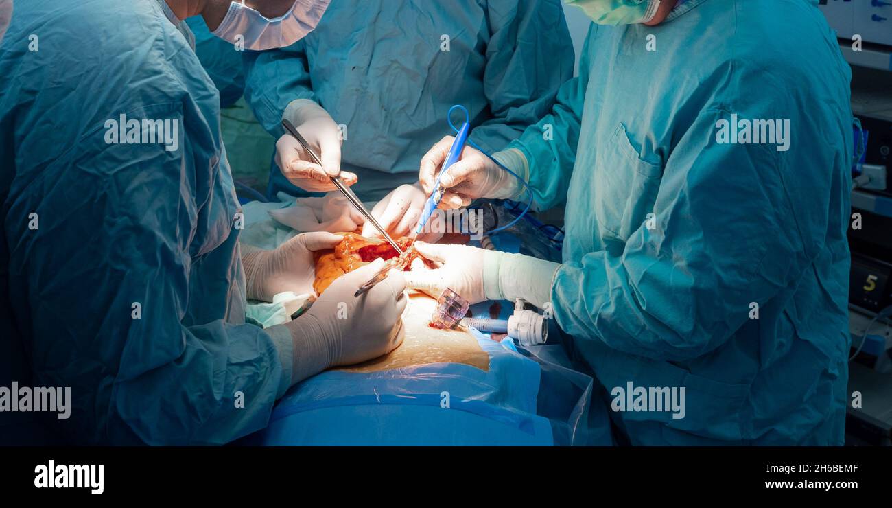 Attention sélective aux mains des chirurgiens en gants stériles pendant la chirurgie.Un groupe de chirurgiens effectue une opération chirurgicale pour retirer une tumeur cancéreuse.Les médecins ont coupé la tumeur maligne. Banque D'Images