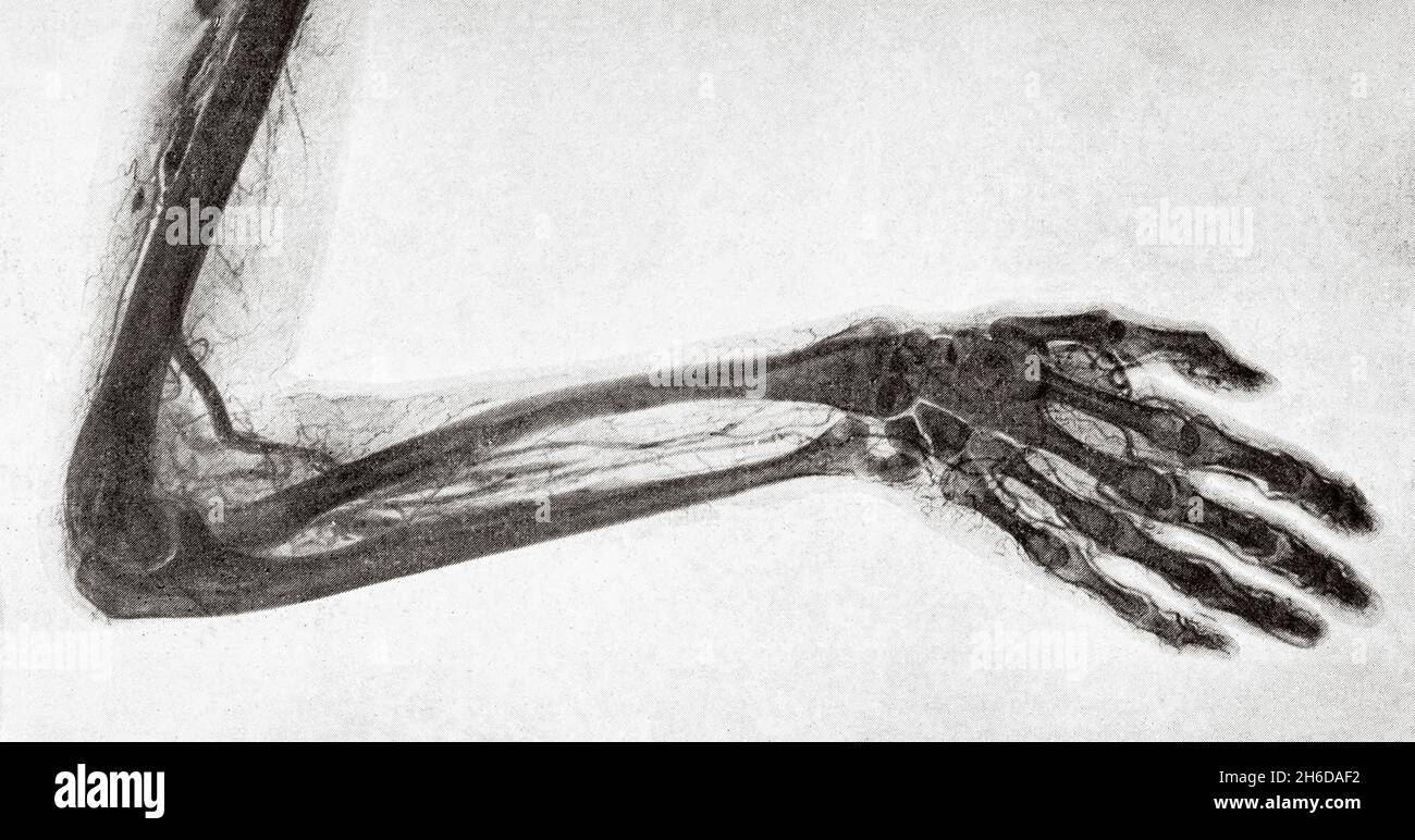 Ancienne photo.Utilisation de rayons X, radiographie obtenue par M Remy.Ancienne illustration gravée du XIXe siècle de la nature 1897 Banque D'Images