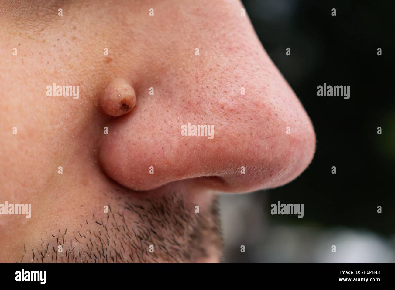 Néoplasme sur le visage près du nez d'une personne qui ressemble à une verrue ou à un papillome Banque D'Images
