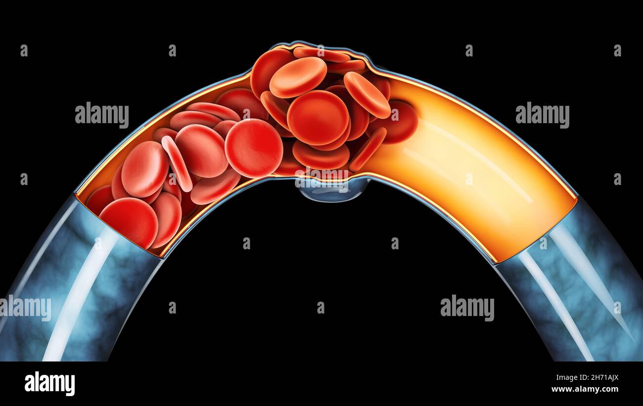 illustration 3d de thrombose veineuse profonde ou de caillots sanguins.Embolie, masque inclus Banque D'Images