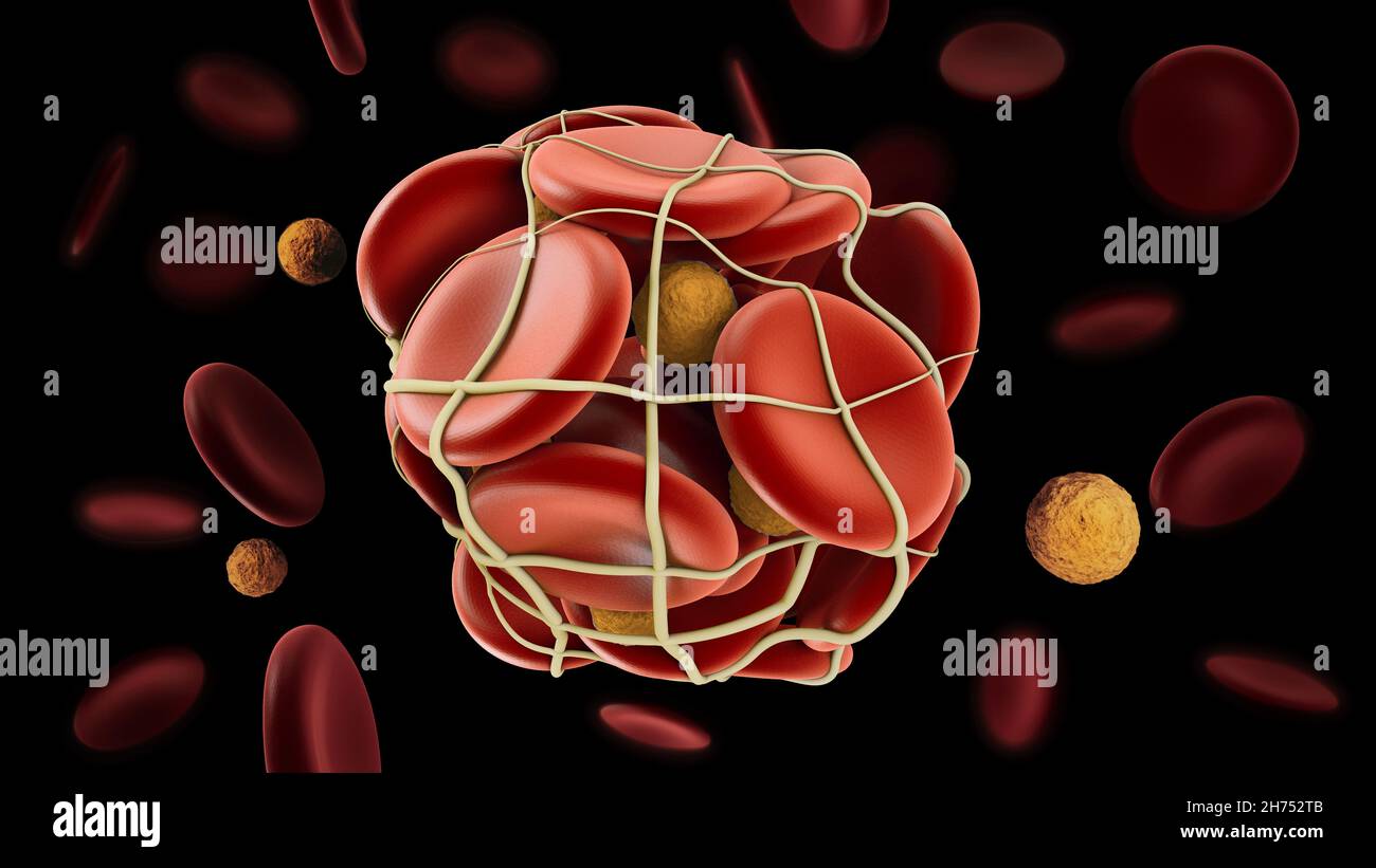 illustration 3d de thrombose veineuse profonde ou de caillots sanguins.Embolie, masque inclus Banque D'Images