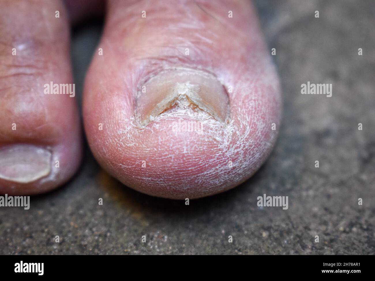 Crapaule endommagée et fissurée.Infection fongique des ongles.Onychomycose, également appelé Tinea unguium. Banque D'Images
