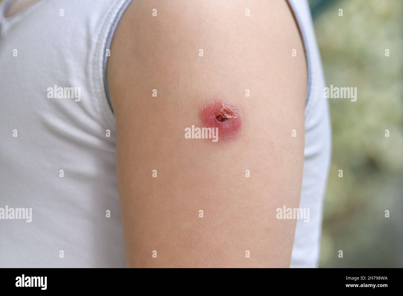 Cicatrice de vaccin Banque de photographies et d'images à haute résolution  - Alamy