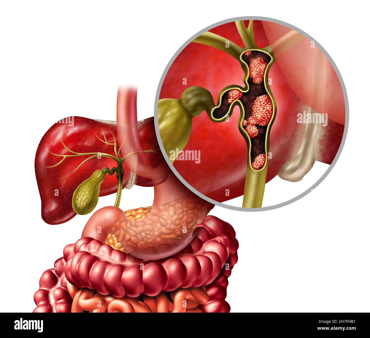 Cancer Du Canal Biliaire Ou Cholangiocarcinome Avec Une V sicule 