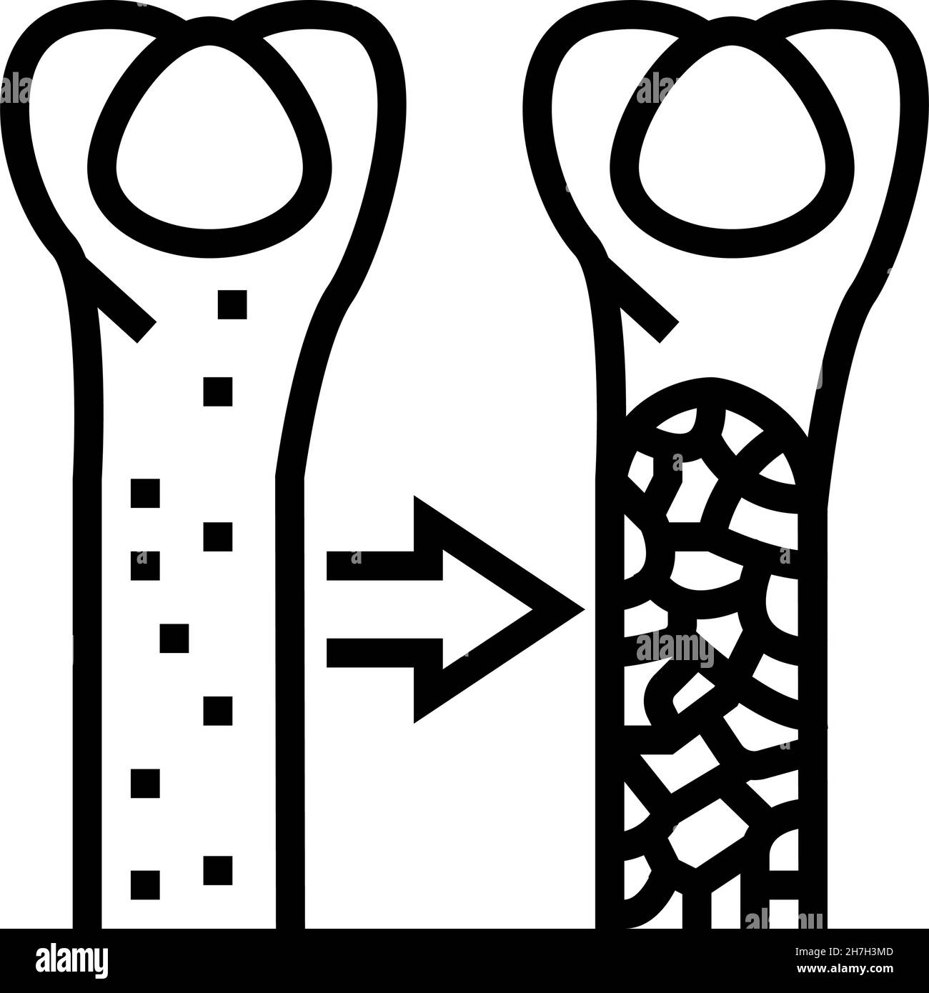 illustration du vecteur de l'icône de la ligne de la maladie osseuse de l'ostéoporose Illustration de Vecteur