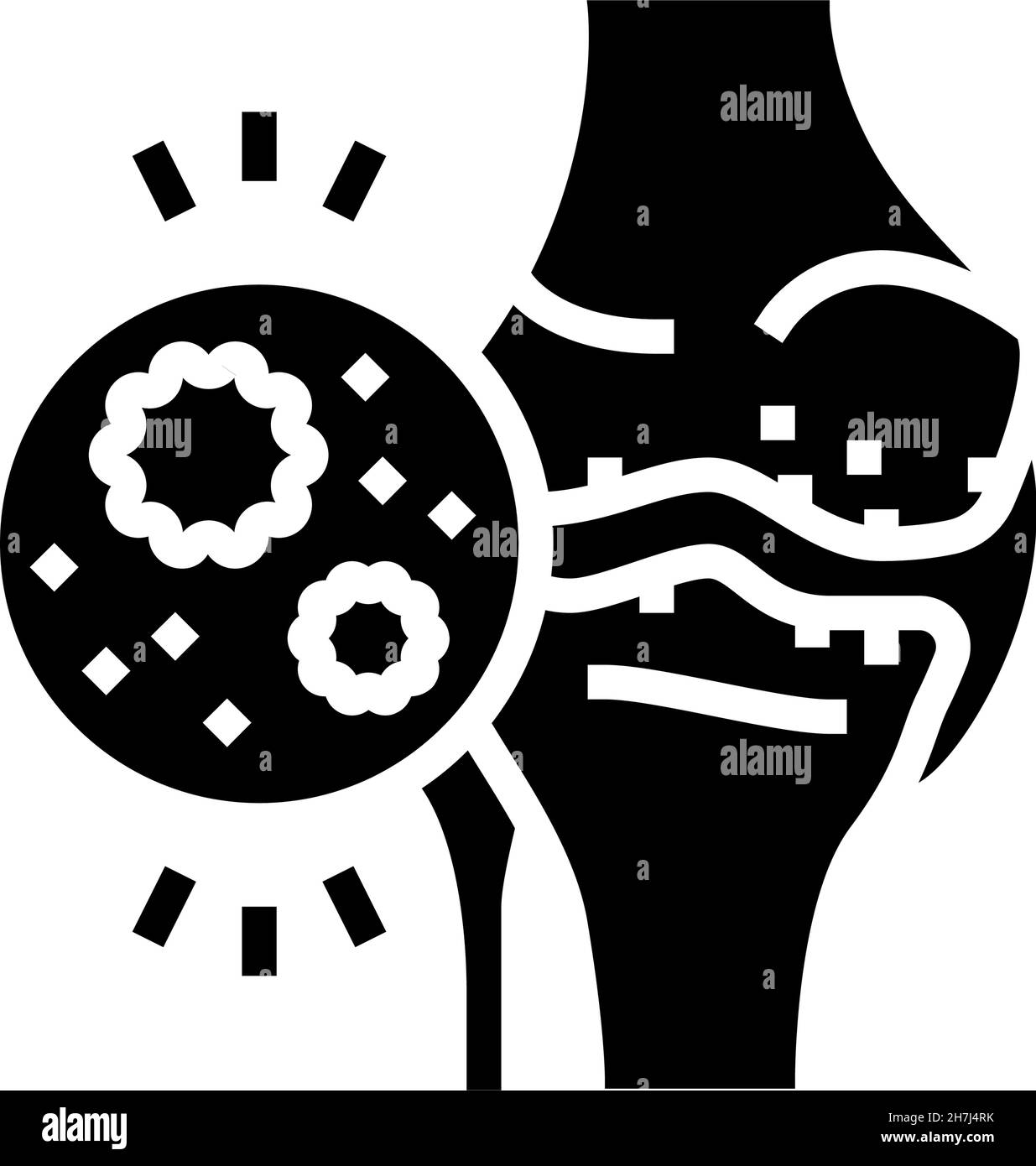 illustration d'un vecteur d'icône de glyphe d'arthrite infectieuse Illustration de Vecteur