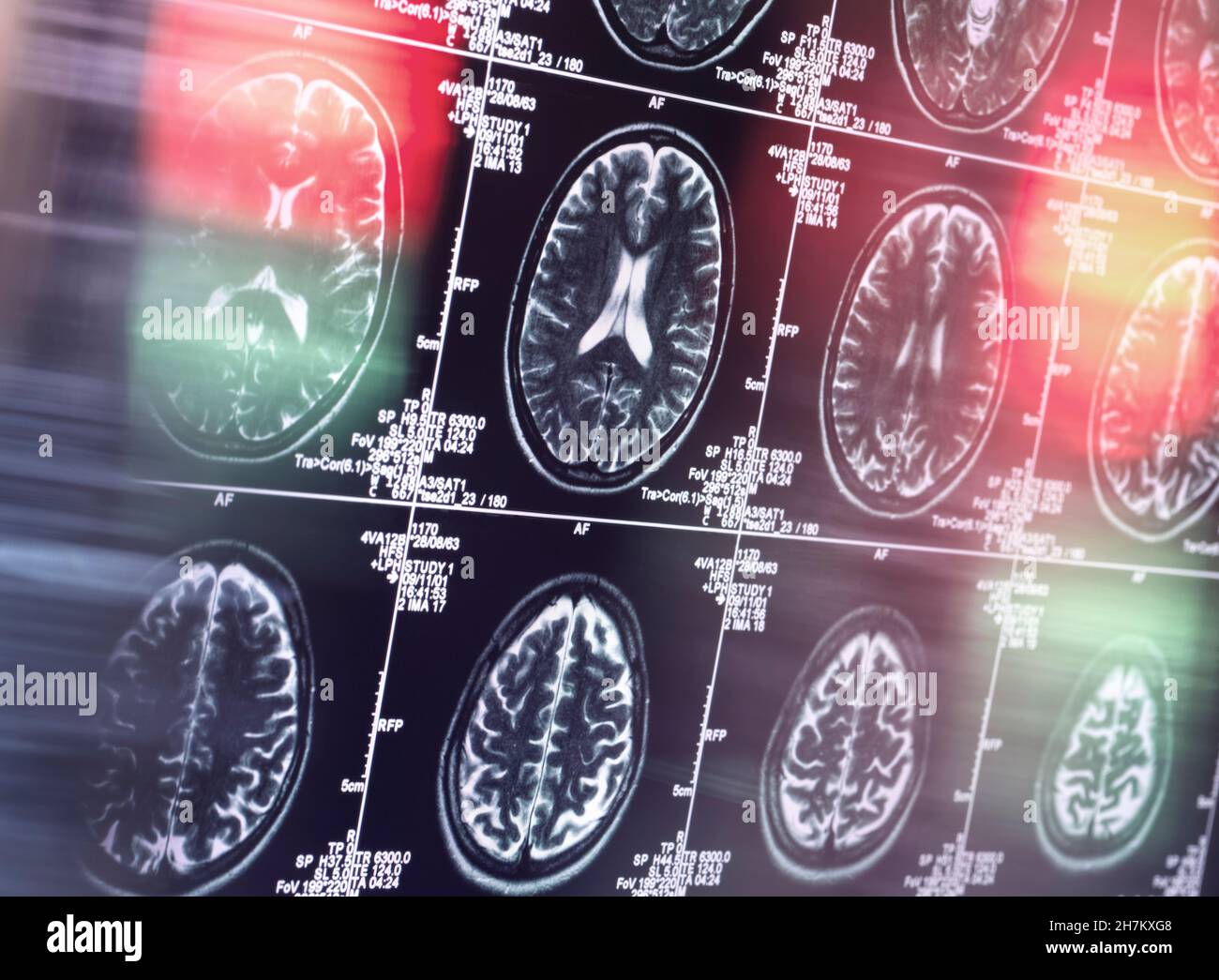 IRM du cerveau en clinique Banque D'Images