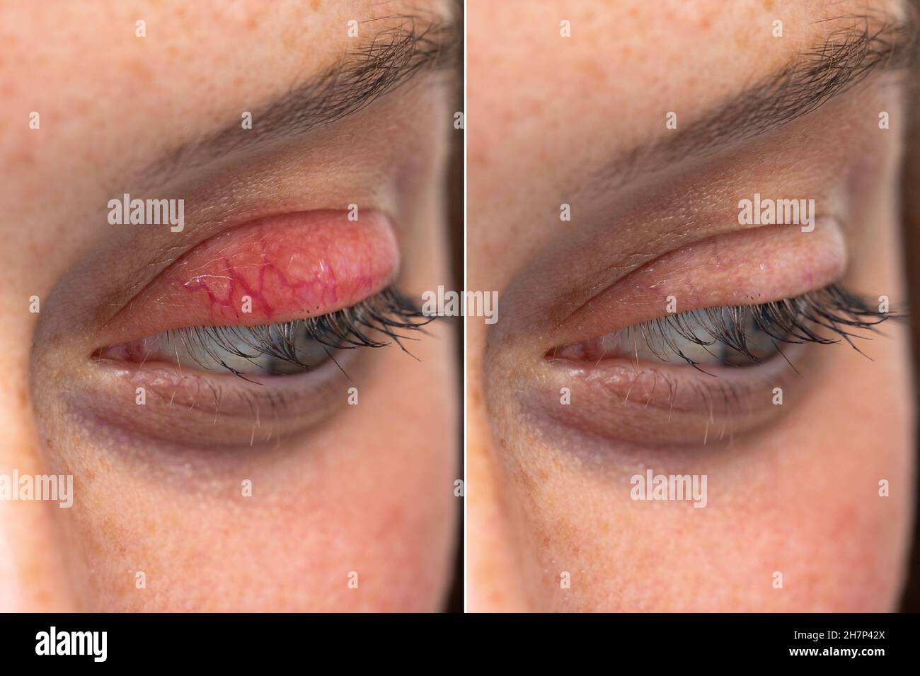 Chalazion de la paupière supérieure de l'œil humain avant et après la  comparaison de la blépharite côte à côte Photo Stock - Alamy