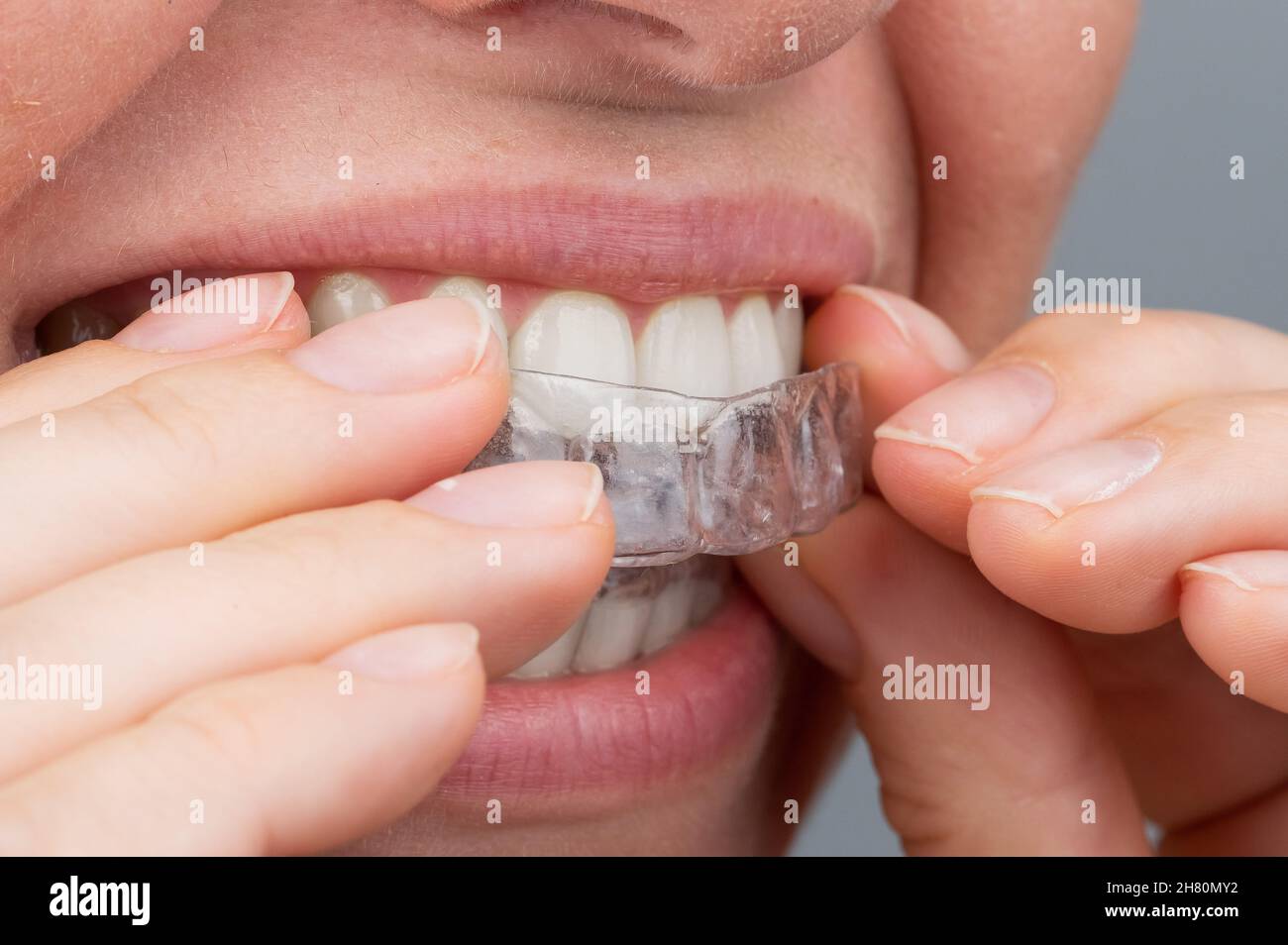 Femme caucasienne mettant sur des aligneurs.Dispositif de lissage des dents orthodontiques. Banque D'Images