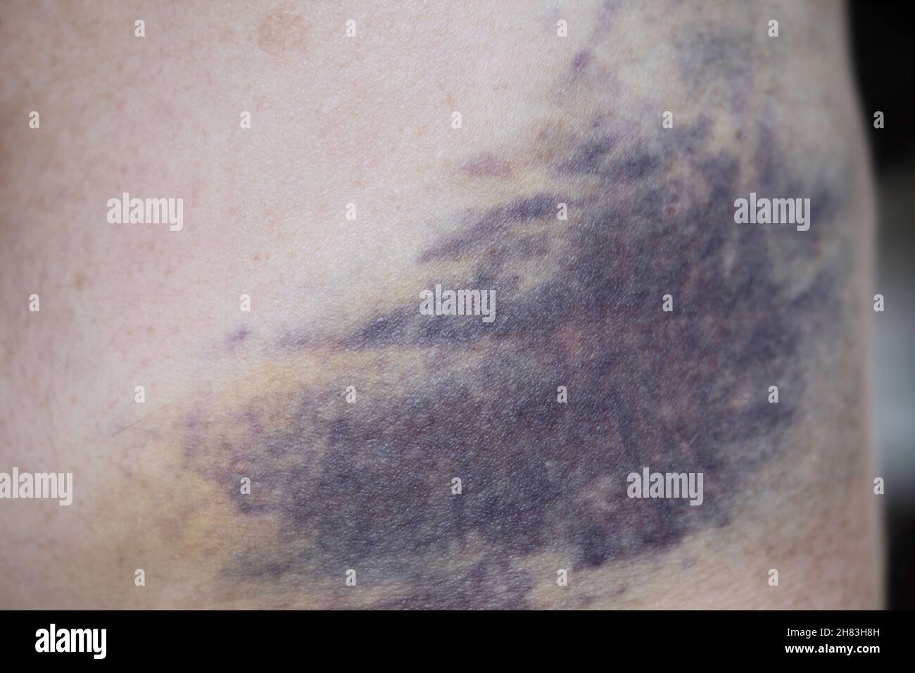 Ecchymoses sous-cutanées ou hématome visible sur la peau un peu pâle sur le bas de l'abdomen d'une personne Banque D'Images