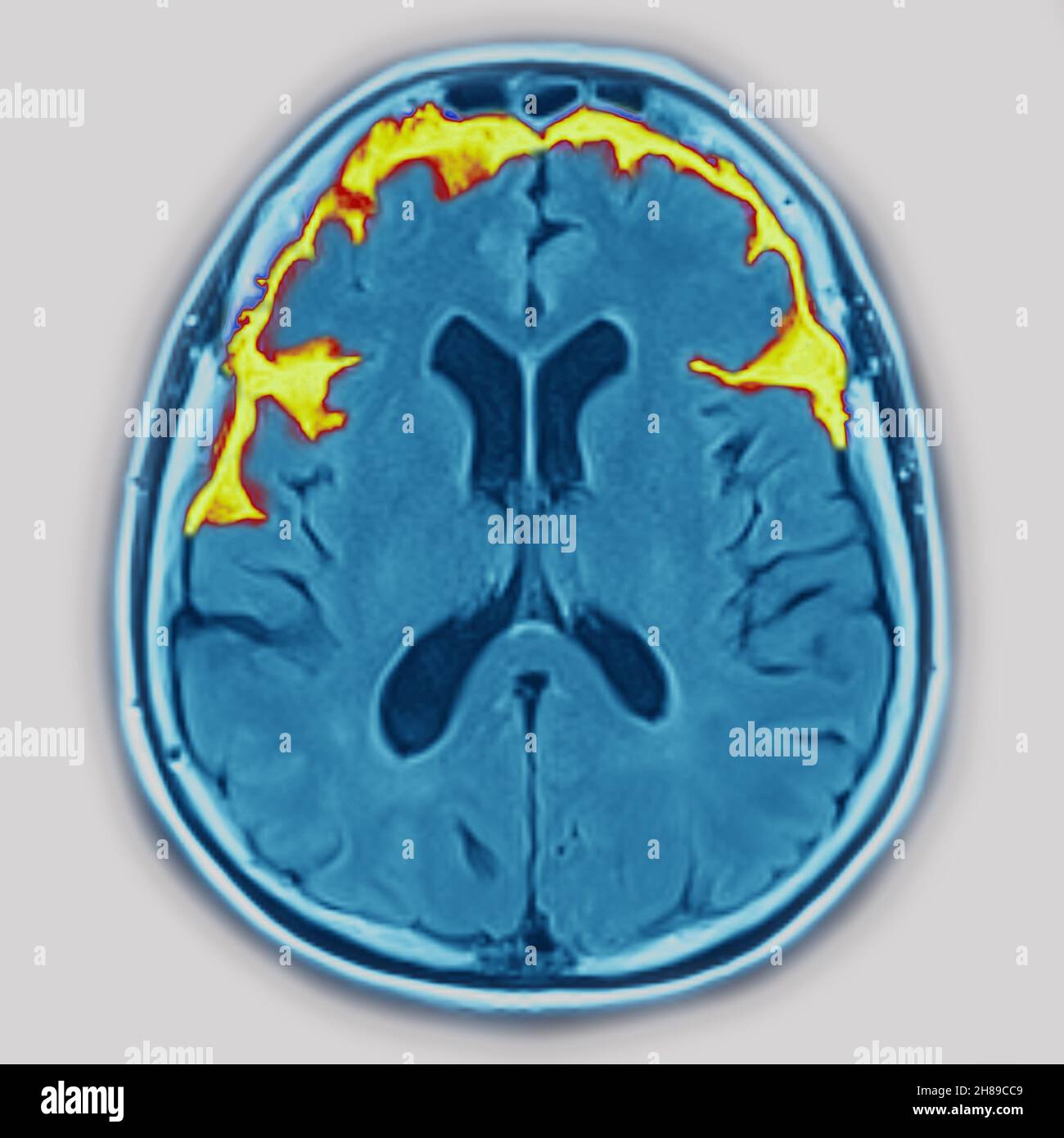 Atrophie cérébrale Banque D'Images