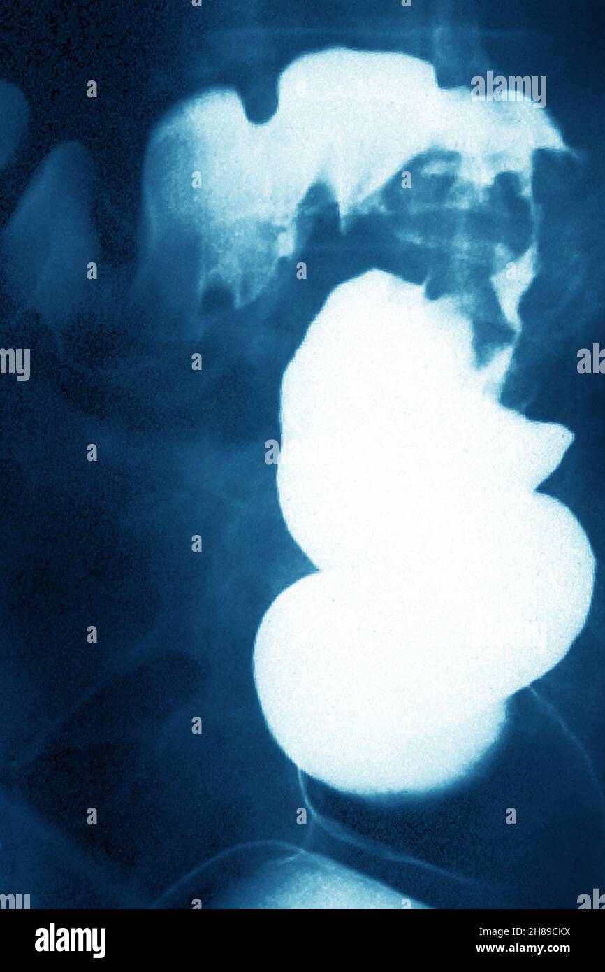 Le cancer colorectal Banque D'Images