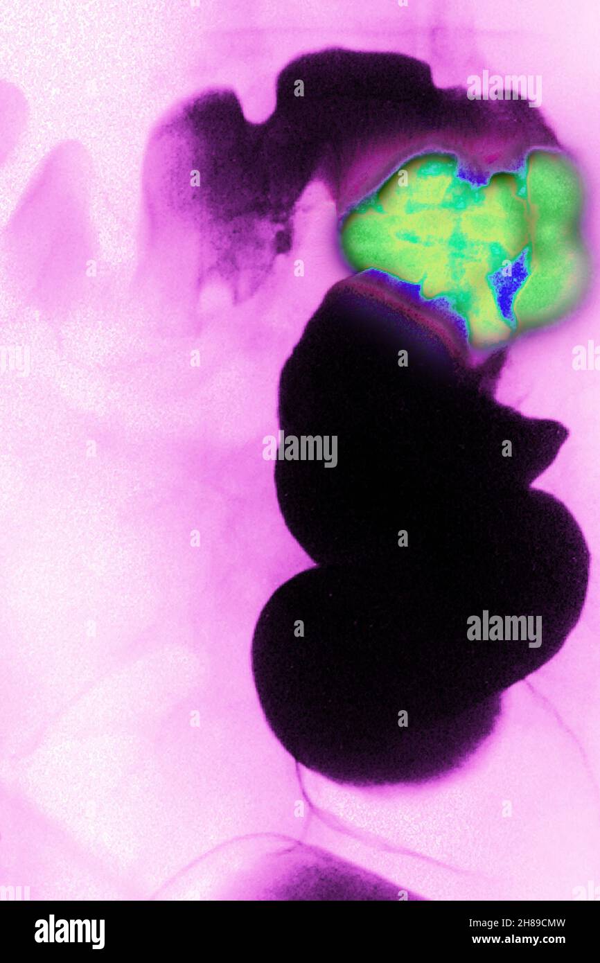 Le cancer colorectal Banque D'Images