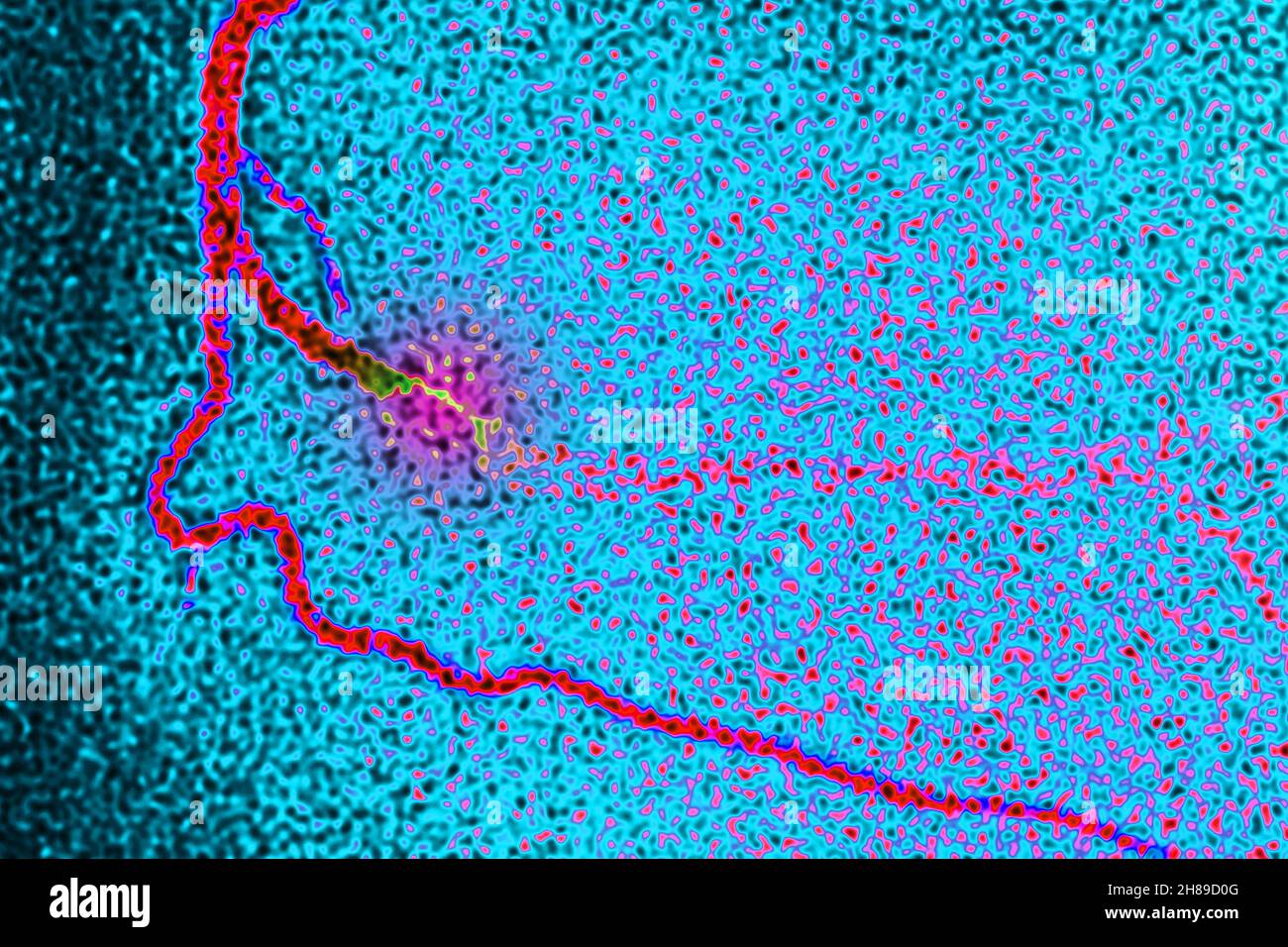 Infarctus du myocarde Banque D'Images