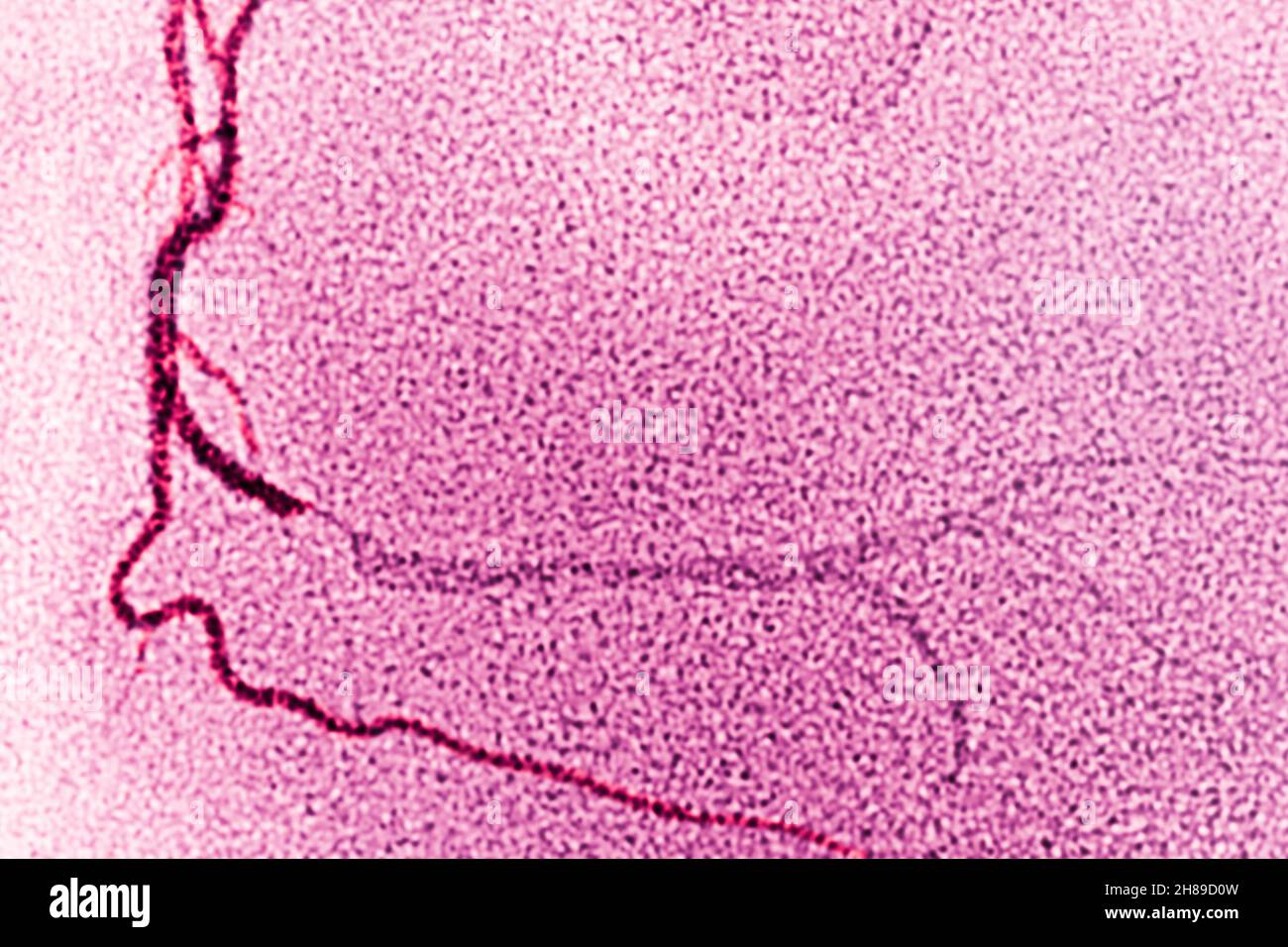 Infarctus du myocarde Banque D'Images
