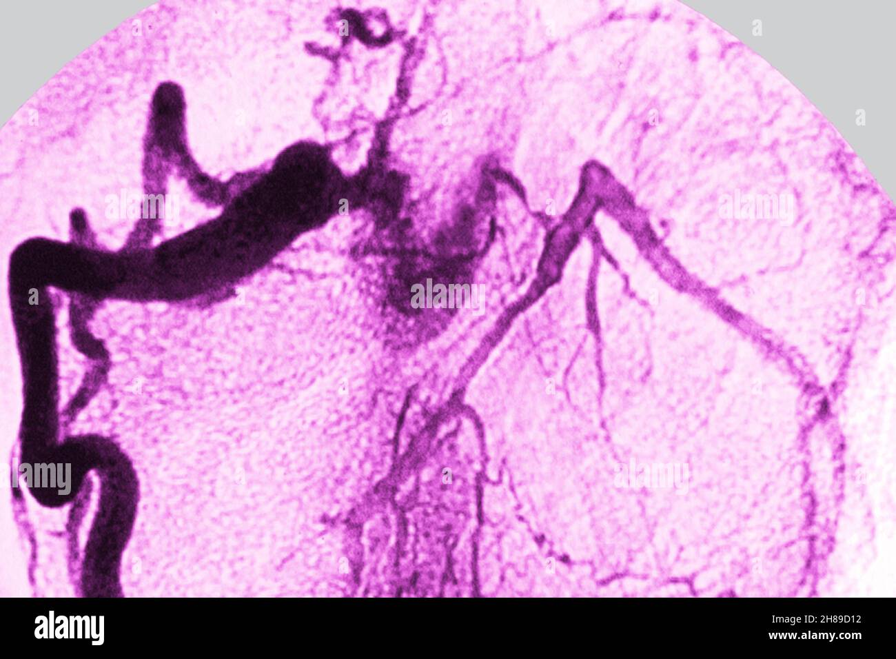 Infarctus du myocarde Banque D'Images