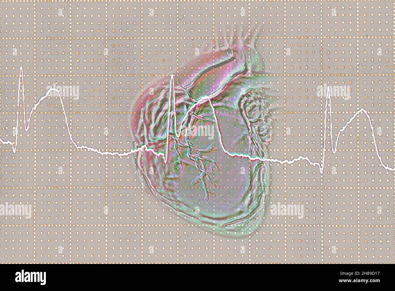 Infarctus du myocarde Banque D'Images