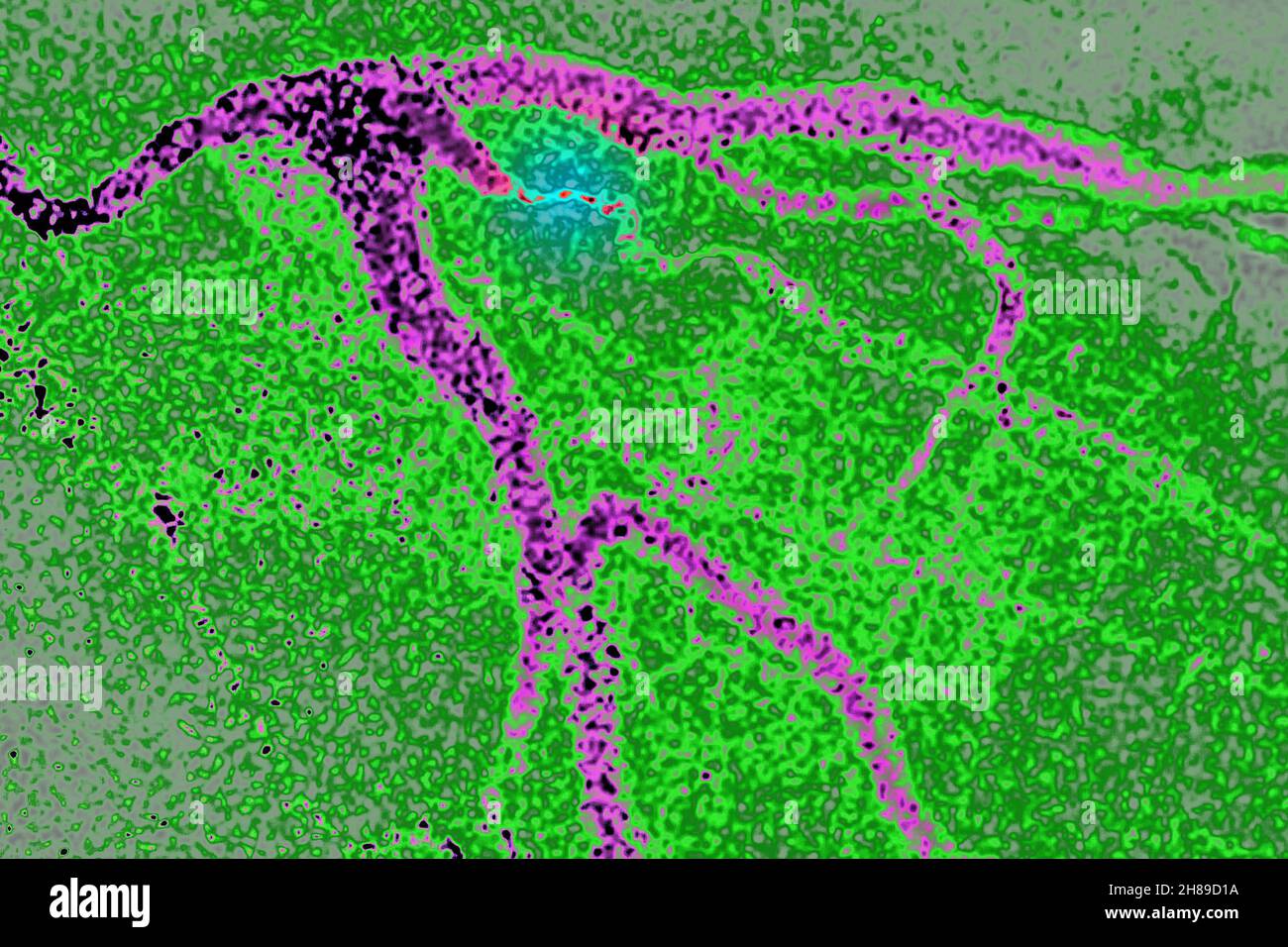 Infarctus du myocarde Banque D'Images