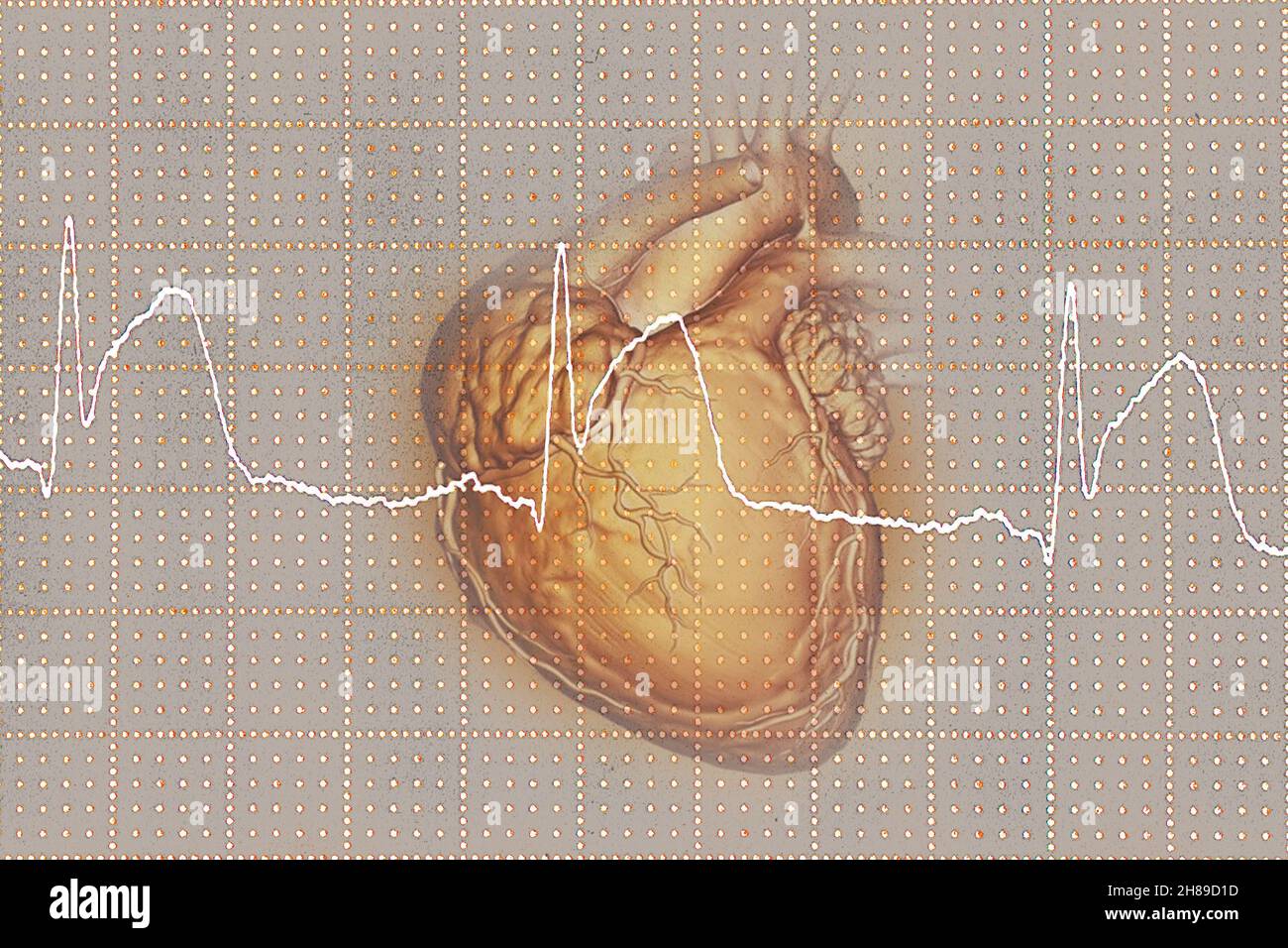 Infarctus du myocarde Banque D'Images