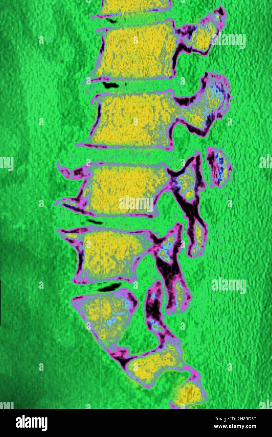 Maladie dégénérative du disque lombaire Banque D'Images