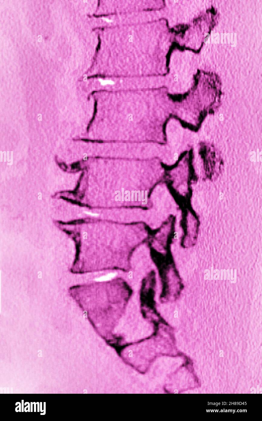 Maladie dégénérative du disque lombaire Banque D'Images
