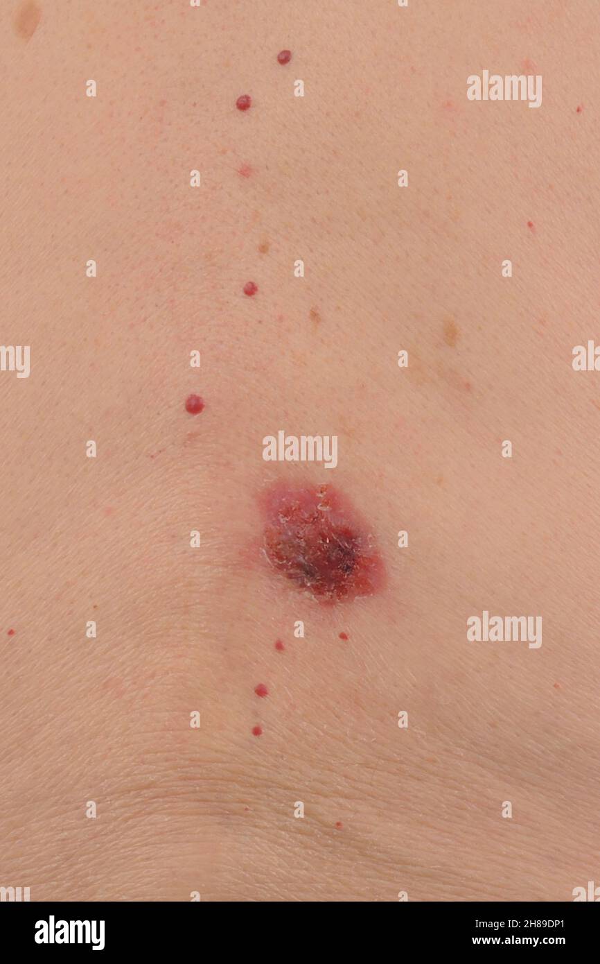 Le carcinome baso-cellulaire Banque D'Images