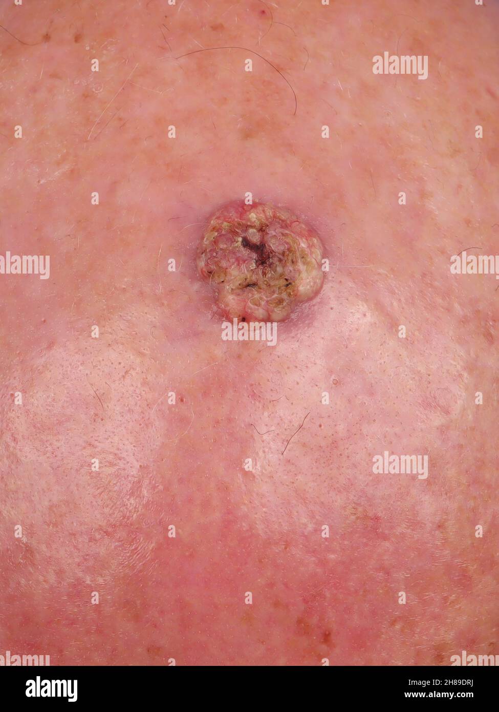 Carcinome épidermoïde invasif Banque D'Images