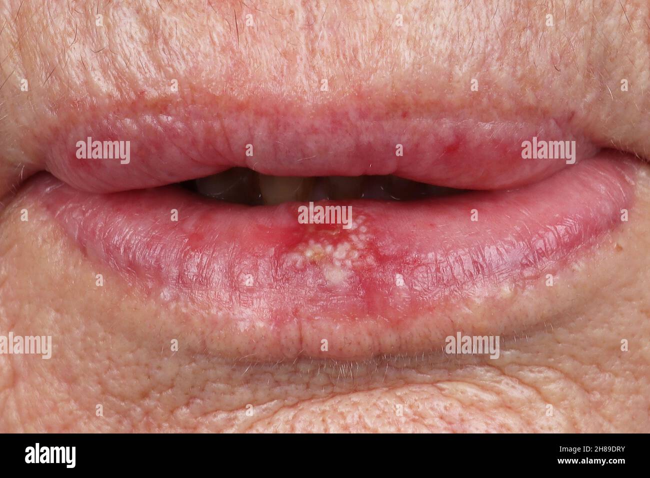 Maladie des lèvres Banque de photographies et d'images à haute résolution -  Alamy