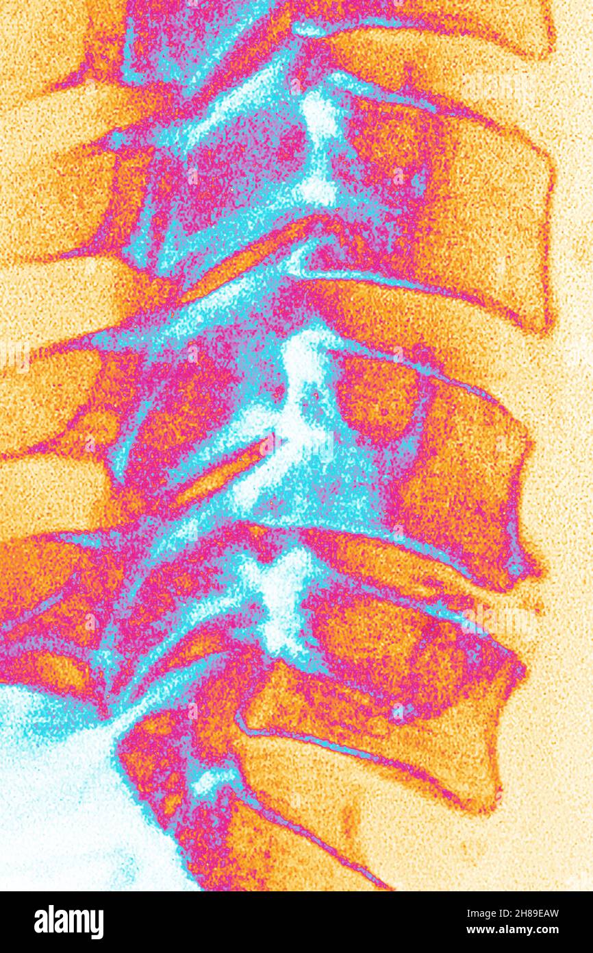 Arthrose des vertèbres cervicales Banque D'Images