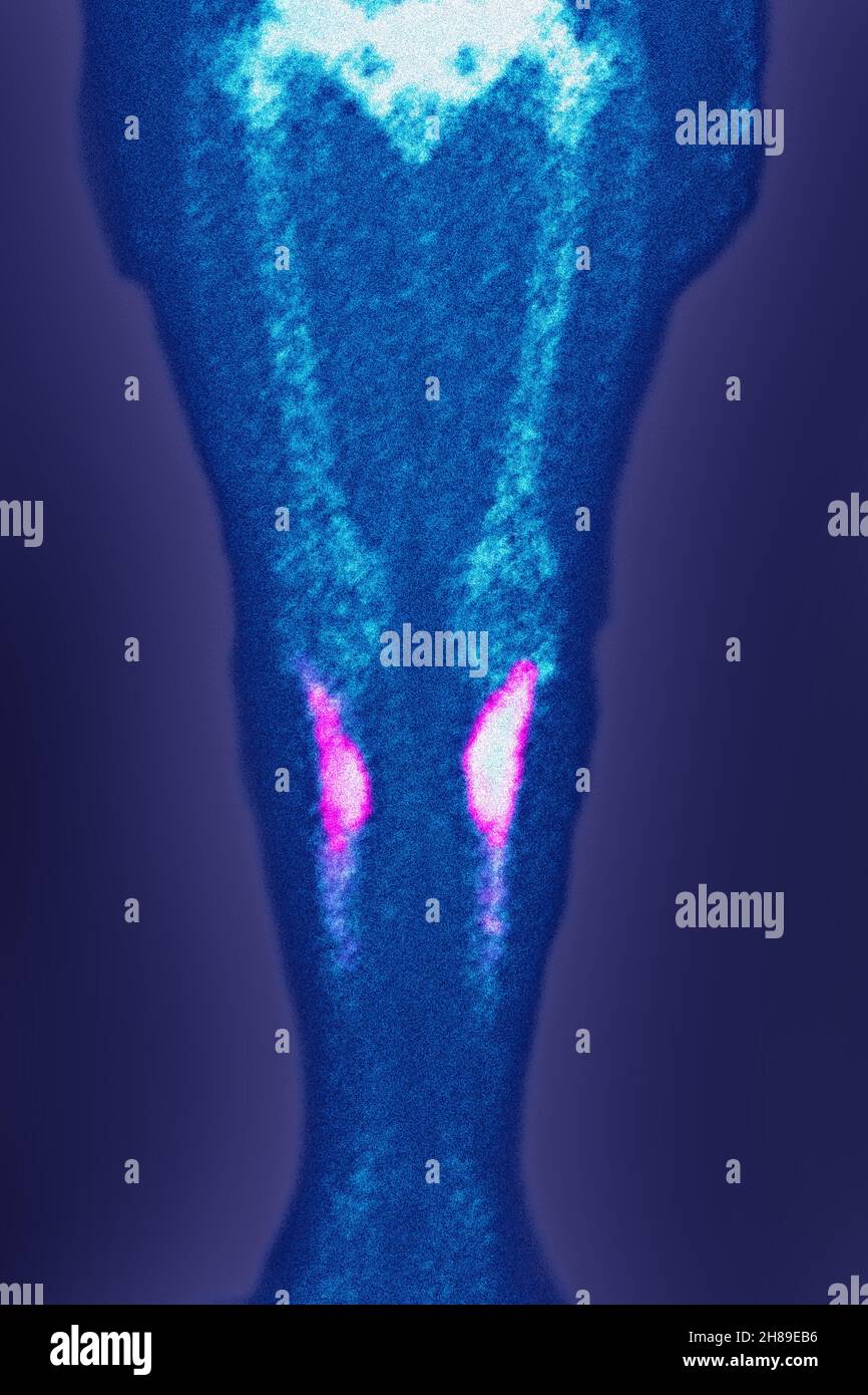 Fractures de stress Banque D'Images