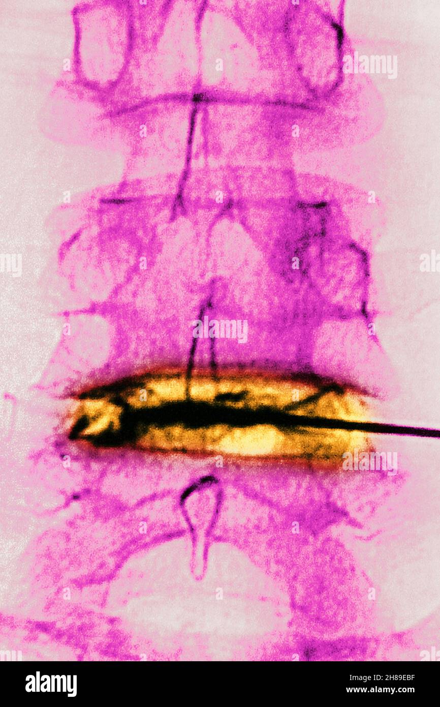 Infiltration de corticostéroïdes Banque D'Images
