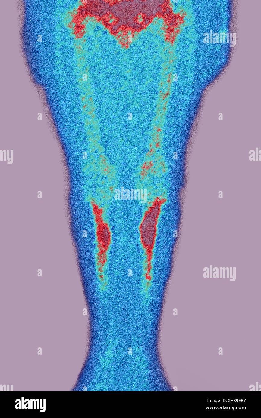 Fractures de stress Banque D'Images